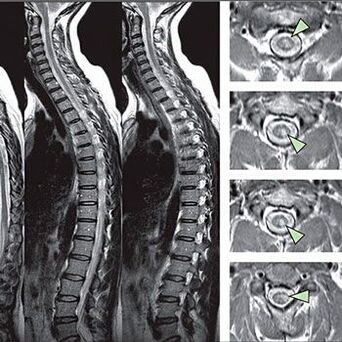 Diagnostic d'ostéochondose thoracique