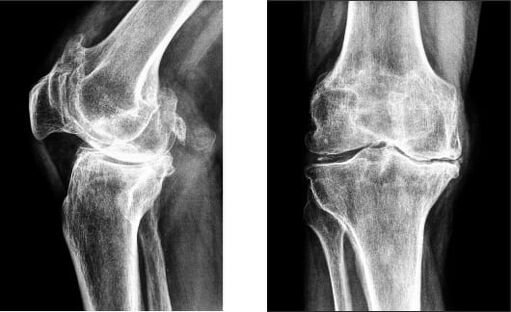 Gonarthrose de l'articulation du genou à la radiographie.