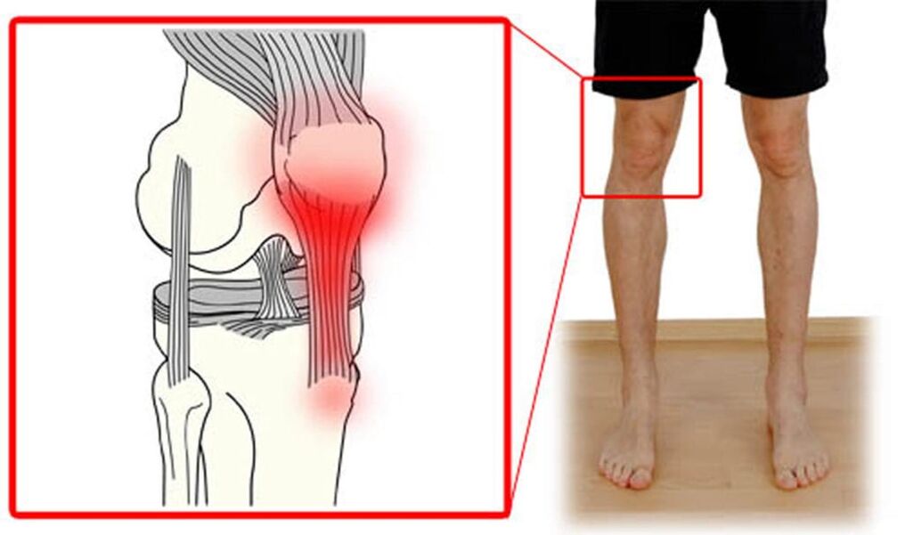 Tendinite, inflammation des tendons de l'articulation du genou.