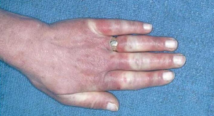 Tableau clinique du syndrome de Raynaud vasospasme, hyperémie, œdème.