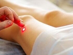 Traitement de l'arthrose articulaire du genou avec un laser